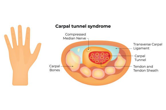 Download Carpal Tunnel Syndrome Science Design - Tunnel Collection